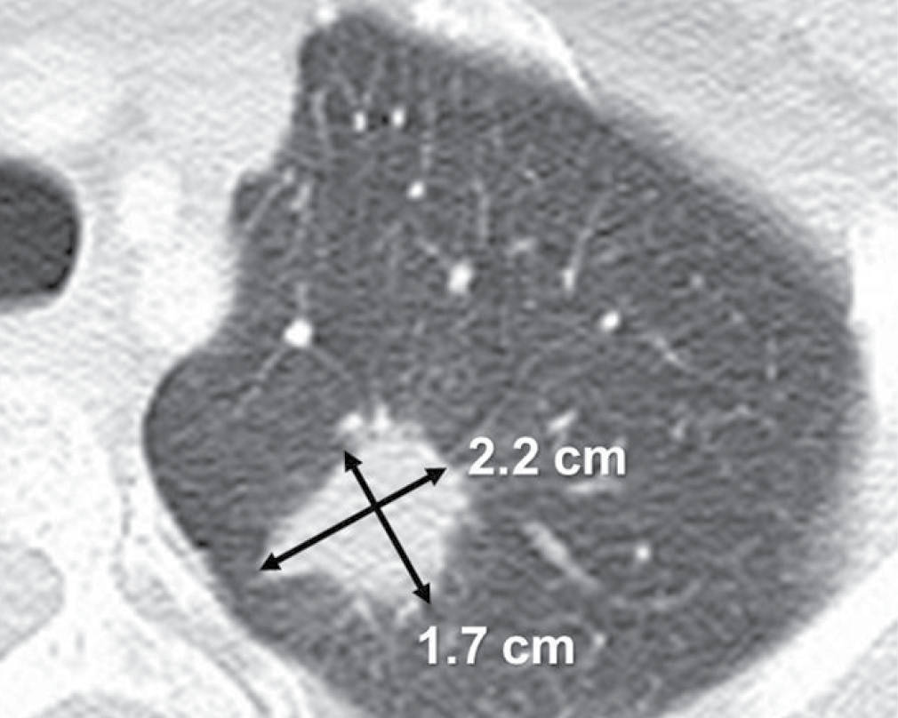 Unidimensional and bidimensional tumor measurements, CT scan of the chest